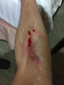 腿受伤照片真实的,康复之路与生活挑战