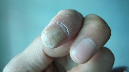 手指脱皮图片,图片解析与预防攻略